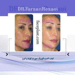 ﻟﻴﻔﺖ ﺍﻧﺪﻭﺳﻜﻮﭘﻴﻚ ﺻﻮﺭﺕ ﮔﻮﻧﻪ و ابرو