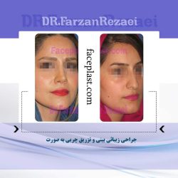 ﺟﺮﺍﺣﻲ ﺯﻳﺒﺎﺋﻲ ﺑﻴﻨﻲ ﻭ ﺗﺰﺭﻳﻖ ﭼﺮﺑﻲ به صورت