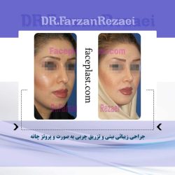 جراحي زيبائي بيني