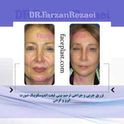 ﺗﺰﺭﻳﻖ ﭼﺮﺑﻲ ﻭ ﺟﺮﺍﺣﻲ ﺗﺮﻣﻴﻢ ﺑﻴﻨﻲ ﻟﻴﻔﺖ ﺍﻧﺪﻭﺳﻜﻮﭘﻴﻚ ﺻﻮﺭﺕ ﺍﺑﺮﻭ ﻭ ﮔﺮﺩﻥ