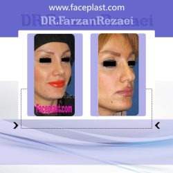 جراحی زیبایی بینی