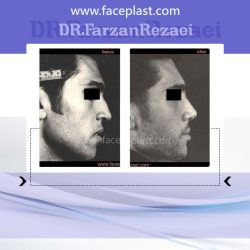 جراحی زیبایی بینی