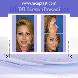 جراحی زیبایی بینی