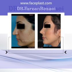 جراحی زیبایی بینی