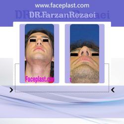 جراحي زيبائي بيني