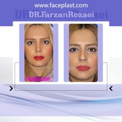 جراحی زیبایی بینی