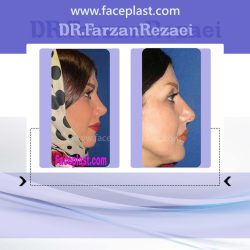 جراحی زیبایی بینی