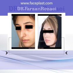 جراحی زیبایی بینی