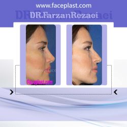 جراحی زیبایی بینی