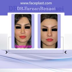 جراحي زيبائي بيني