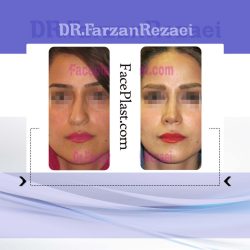 جراحی زیبایی بینی