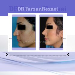 جراحی زیبایی بینی