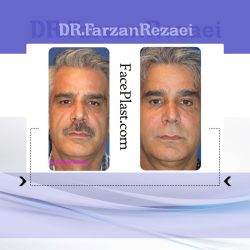جراحى پلك پايين، جوان سازى صورت با تزريق چربى