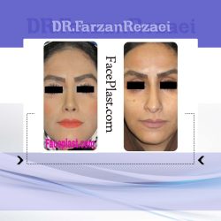 عمل زیبایی بینی