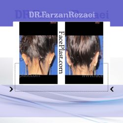 جراحی زیبایی گوش