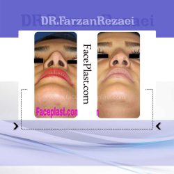 جراحی زیبایی بینی