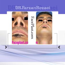 جراحی زیبایی بینی