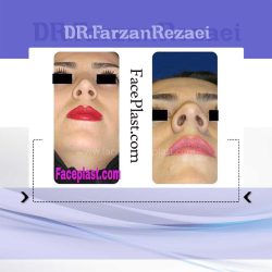 جراحی زیبایی بینی
