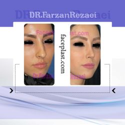 جراحی زیبایی بینی