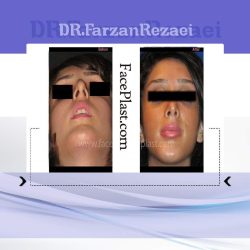 جراحی زیبایی بینی