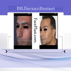 لیفت ابرو و جراحی پلک بالا