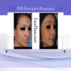 لیفت ابرو و عمل زیبایی بینی