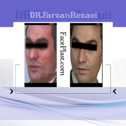 لیفتینگ ابرو و تزریق چربی