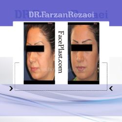 لیفت گونه و ابرو