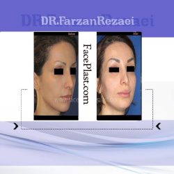 لیفتینگ ابرو و تزریق چربی