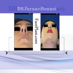جراحی زیبایی بینی