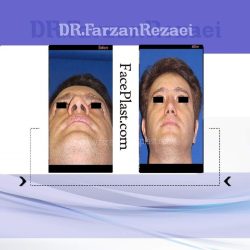 لیفت ابرو و عمل زیبایی بینی