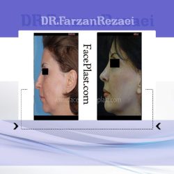 جراحی زیبایی بینی و پروتز چانه