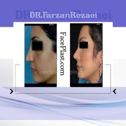 تزریق چربی به صورت و عمل زیبایی بینی