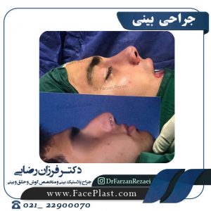 جراحی مجدد بینی