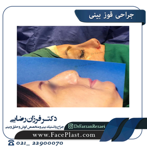 جراحی قوز بینی