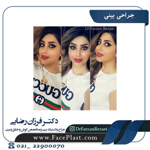 جراحی بینی گوشتی و استخوانی