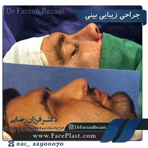 عمل بینی