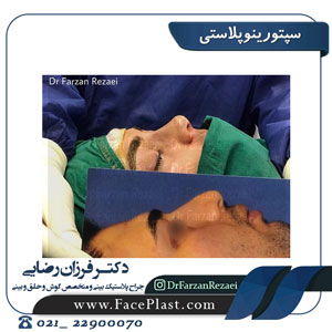 سپتورینوپلاستی