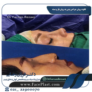 تفاوت روش جراحی بینی به روش باز و بسته