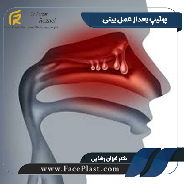 پولیپ بعد از عمل بینی - دکتر فرزان رضایی