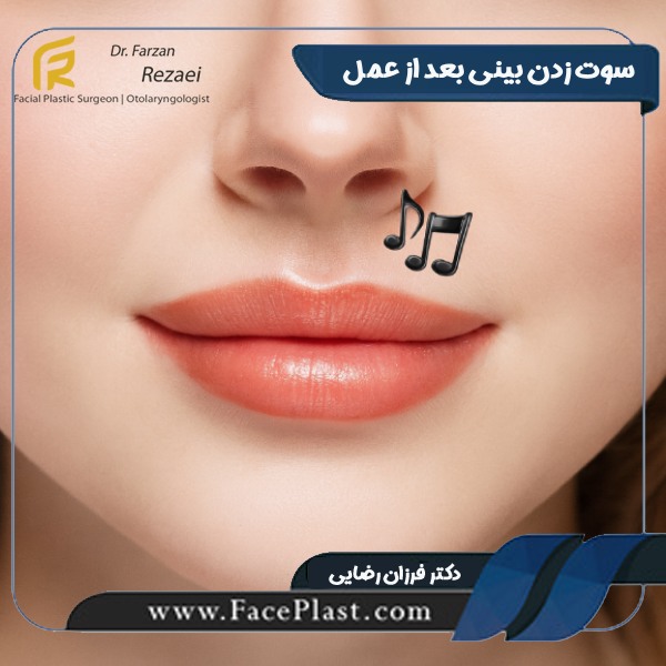 سوت زدن بینی بعد از عمل