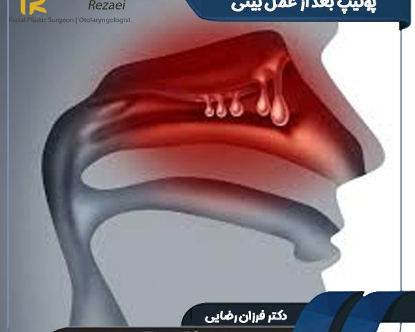 پولیپ بعد از عمل بینی - دکتر فرزان رضایی