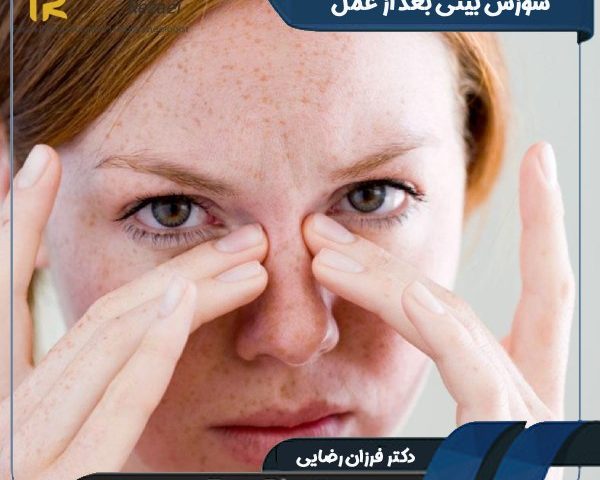 سوزش بینی بعد از عمل