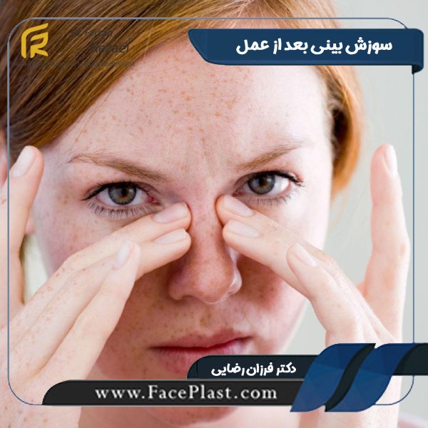 سوزش بینی بعد از عمل