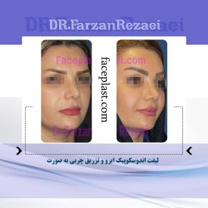 لیفت اندوسکوپیک ابرو و تزریق چربی به صورت