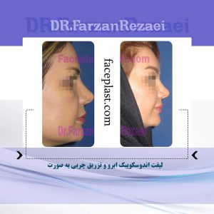 لیفت اندوسکوپیک ابرو و تزریق چربی به صورت