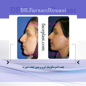ﻟﻴﻔﺖ ﺍﻧﺪﻭﺳﻜﻮﭘﻴﻚ ابرو و ميني ليفت صورت