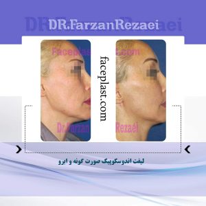 ﻟﻴﻔﺖ ﺍﻧﺪﻭﺳﻜﻮﭘﻴﻚ صورت گونه و ابرو