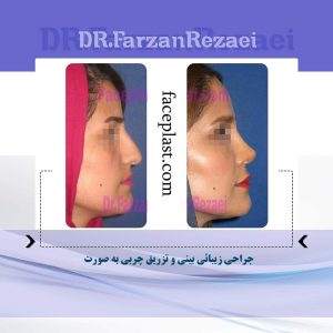 ﺟﺮﺍﺣﻲ ﺯﻳﺒﺎﺋﻲ ﺑﻴﻨﻲ ﻭ ﺗﺰﺭﻳﻖ ﭼﺮﺑﻲ به صورت و پروتز چانه