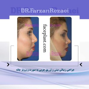 ﺟﺮﺍﺣﻲ ﺯﻳﺒﺎﺋﻲ ﺑﻴﻨﻲ ﻭ ﺗﺰﺭﻳﻖ ﭼﺮﺑﻲ ﺑﻪ ﺻﻮﺭﺕ ﻭ ﭘﺮﻭﺗﺰ ﭼﺎﻧﻪ
